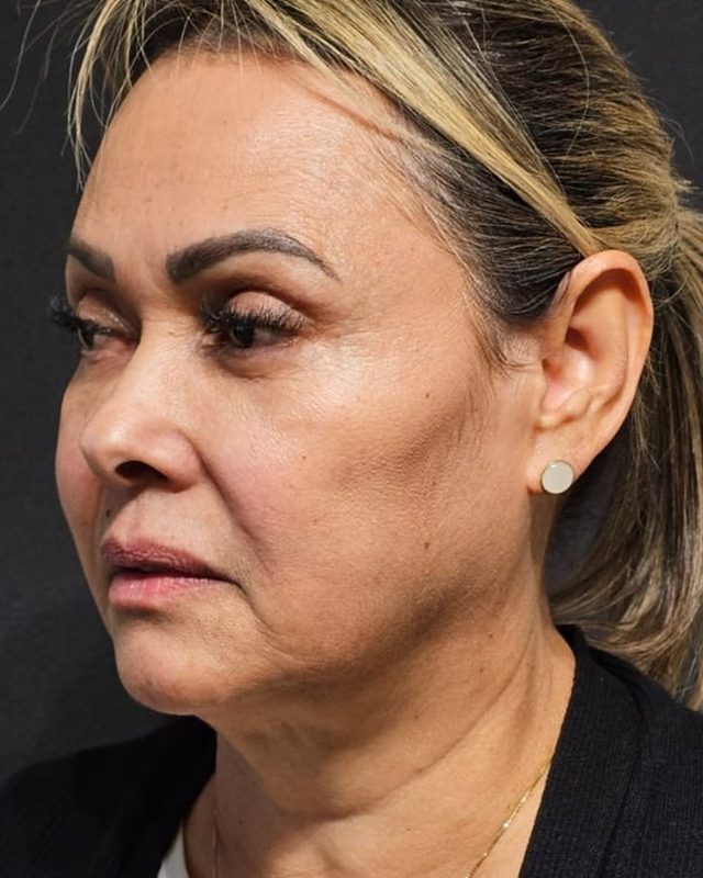 Antes do protocolo lift contour