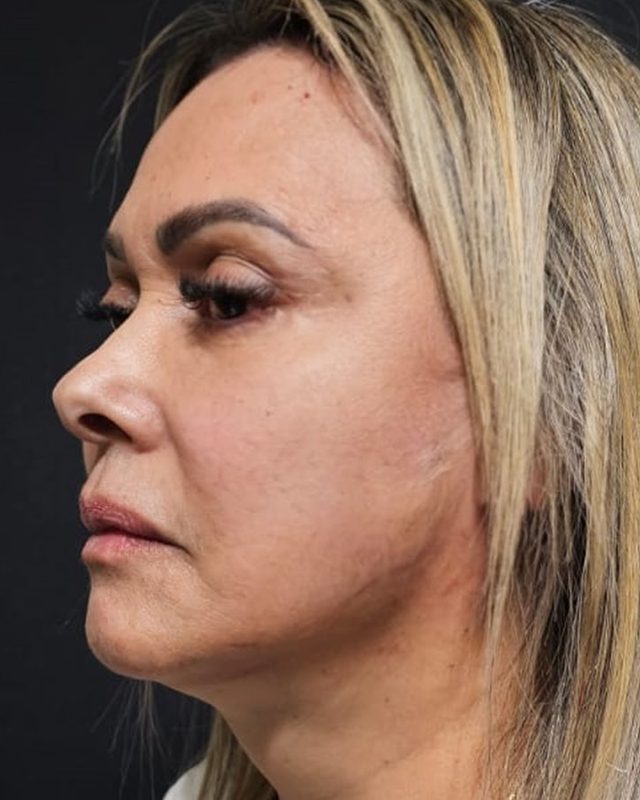 Depois do protocolo lift contour
